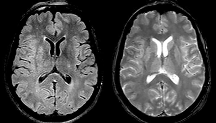 ct scan or mri for brain stroke