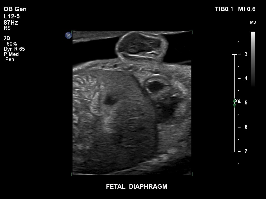 ultrasound first trimester image clinical