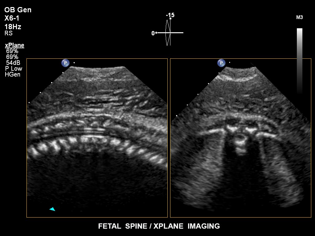ultrasound first trimester image clinical