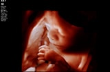 Download image (.jpg) X6 1 Matrix Array transducer with TrueVue on 27 week Fetus (opens in a new window)