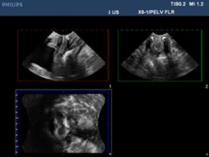 Pelvic floor ultrasound