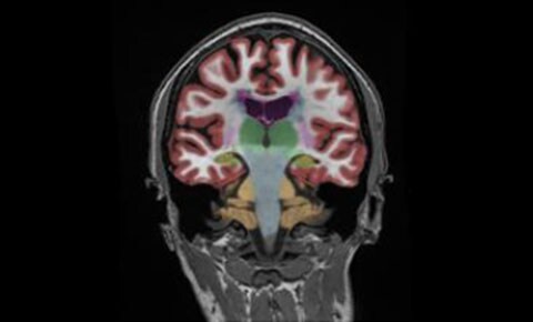 mr neuroquant clinical image