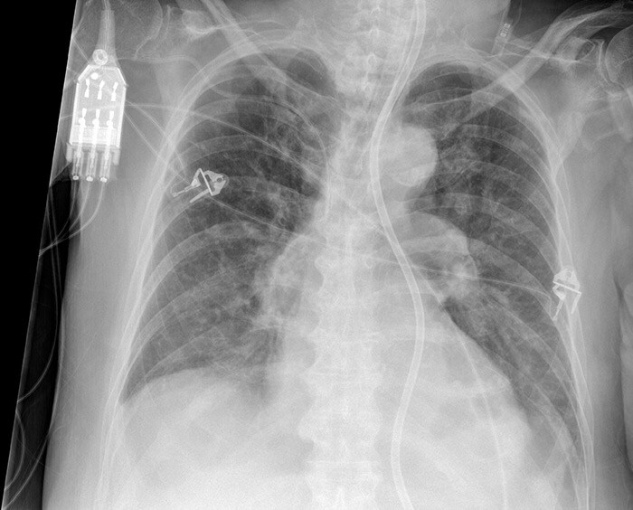 Improving workflow in bedside chest radiography Philips Healthcare