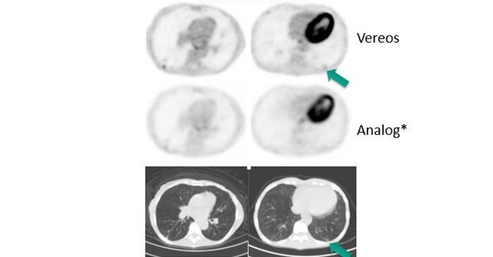 Improved detectability & characterization of small lesions with digital PET