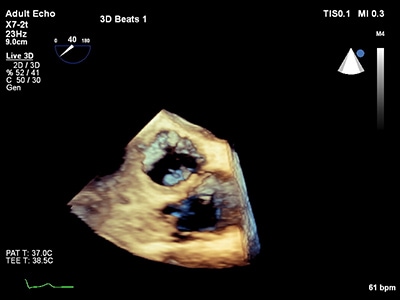 TEE ultrasound clincal image live 3D TEE 1
