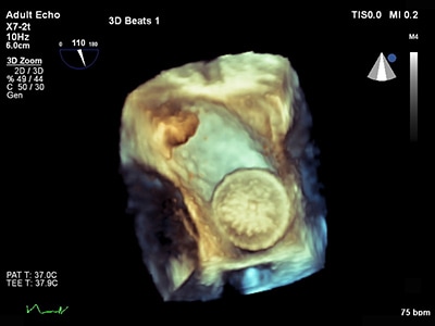 TEE ultrasound clincal image live 3D TEE 2
