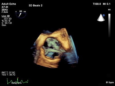 TEE ultrasound clincal image live 3D TEE 3