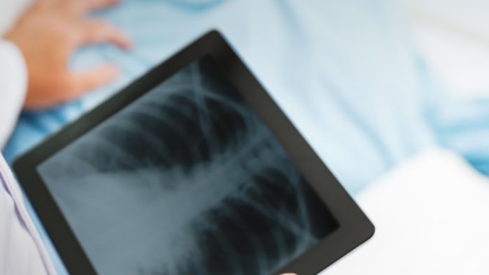 The ROI of pulmonary rehab