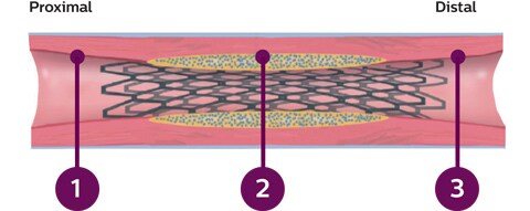 3 IVUS defined criteria 