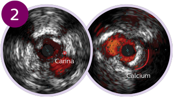 ostial and bifurcation lesions bubbles