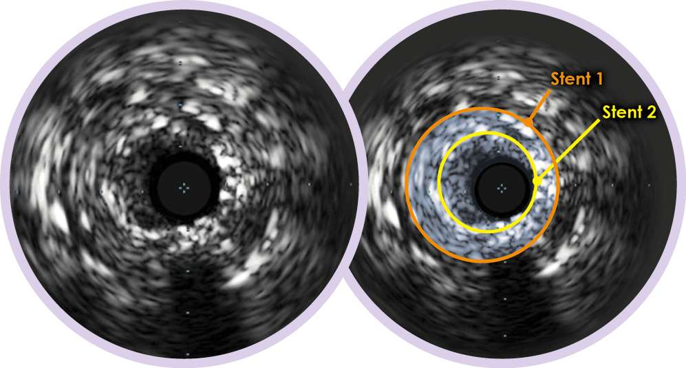 Coronary IVUS Intravascular Ultrasound Philips