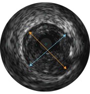 ivus interpretation assessment of vessel size