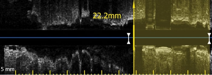 Landing zone/stent length