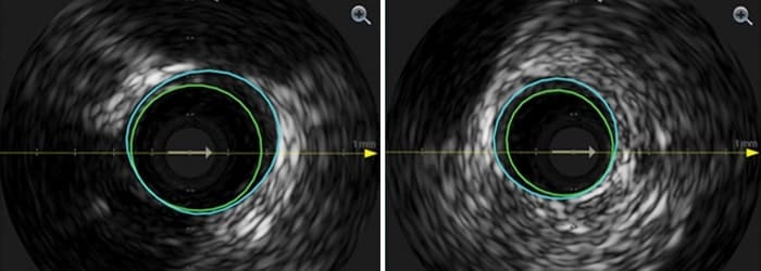 Stent/vessel diameter