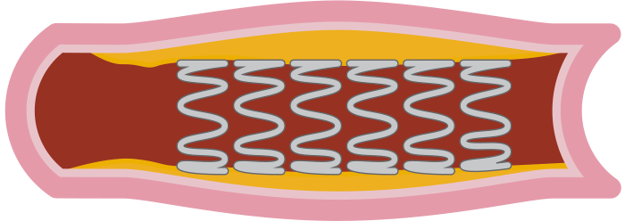 Vessel stent graphic