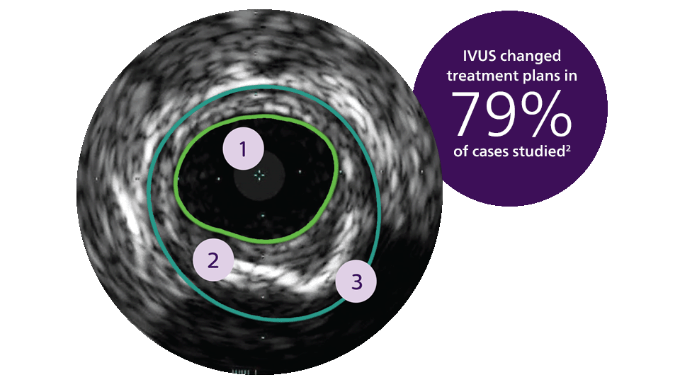 Arterial ivus