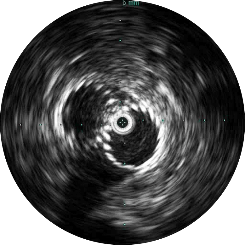 Stent sizing button