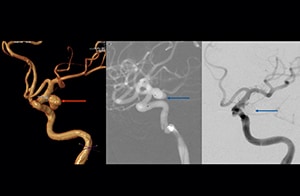 mra aneurysms 4 thmb