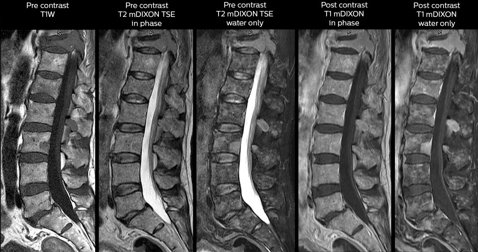 mri in ed back pain