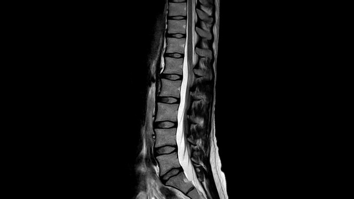 Spine medium