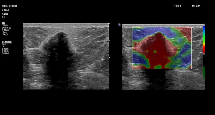 L12-5 Breast Elastography MaxVue