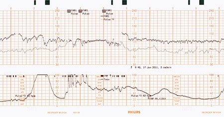 Philips fetal monitoring USA paper speed MP CCV1 rd3cm