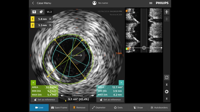 Intravascular Ultrasound (IVUS)