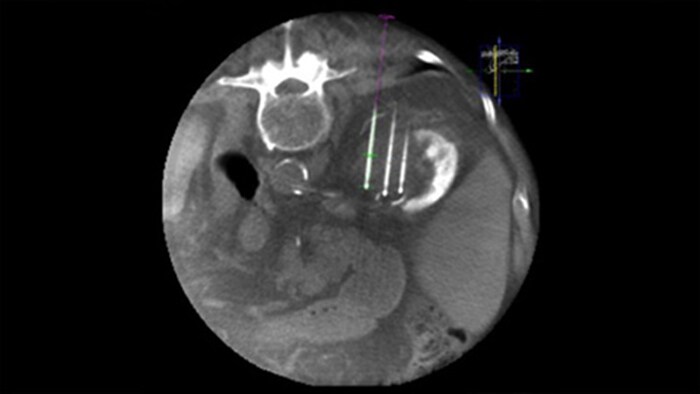 CBCT 3D image using Dual View