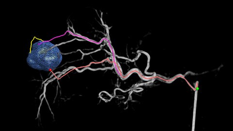 Emboguide detects hepatic nodules and identifies feeder vessel