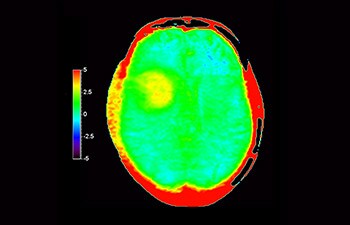 Glioblastoma