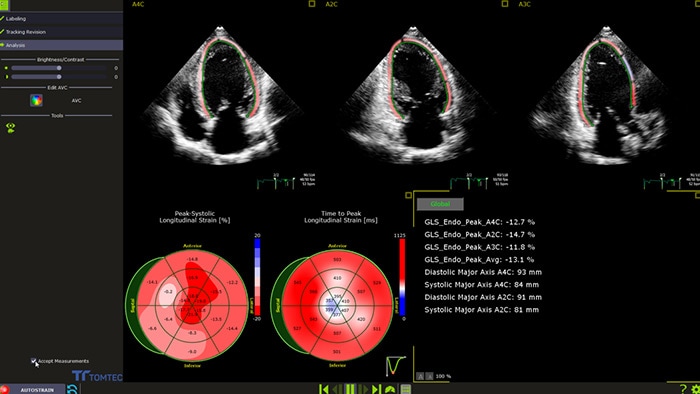 Automated GLS measurement for routine clinical use