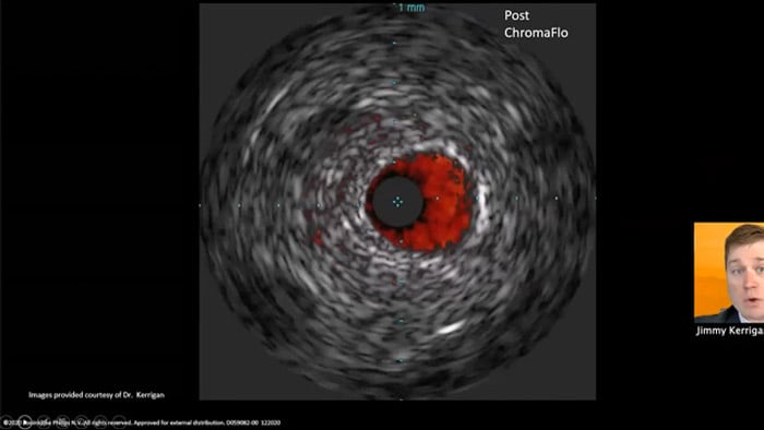 Dr. Jimmy Kerrigan optimizes stents with IVUS