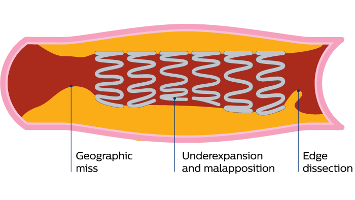 Vessel stent graphic