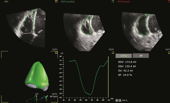 4D Mitral Valve Assessment (MVA)
