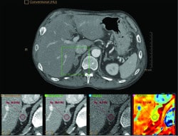 adrenal image