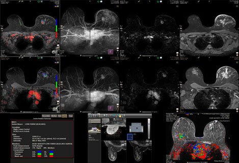 ct lung