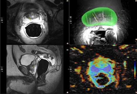 ct lung