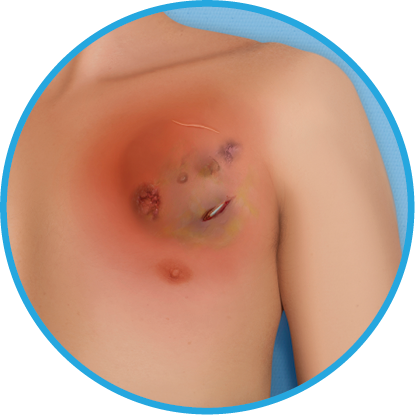 Pocket infection symptom phase 4