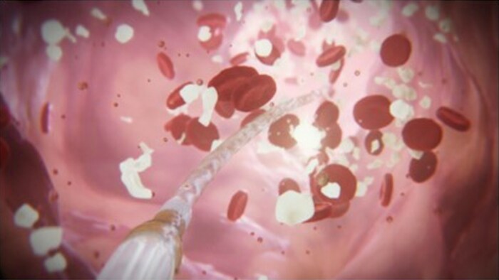 Get inside with IVUS