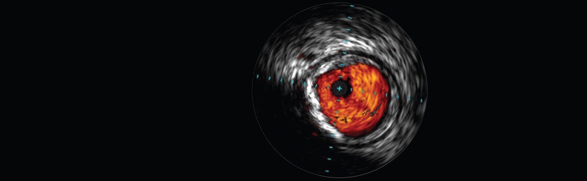 IVUS scan