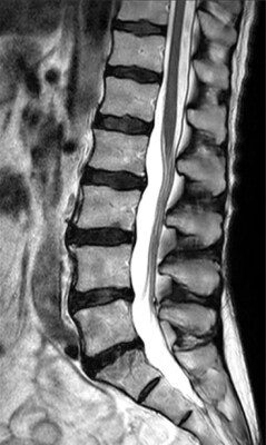 PHH conventional acceleration spine imaging