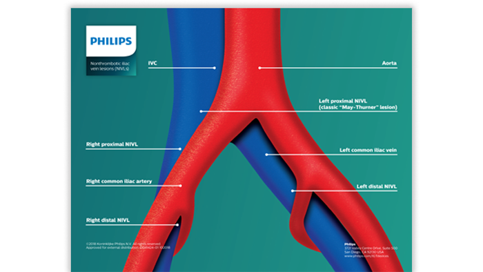 nonthrombotic iliac vein lesions download (.pdf) file