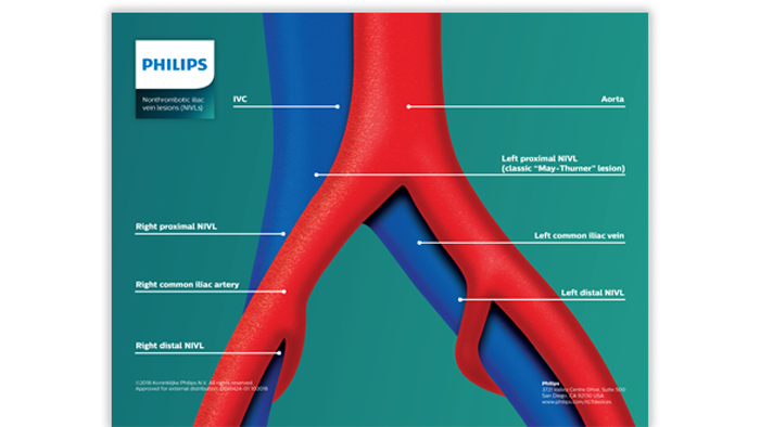 Nonthrombotic-iliac-vein-lesions-image (opens in a new window) download (.pdf) file