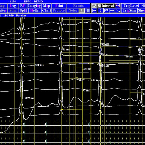 Holter monitoring