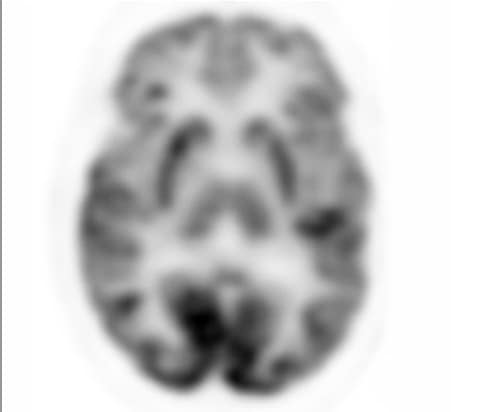 Analog PET scan brain
