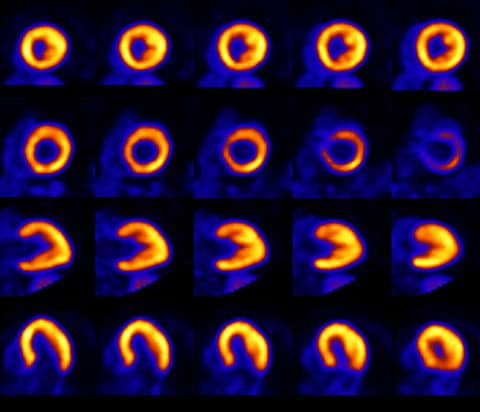 Analog PET scan heart