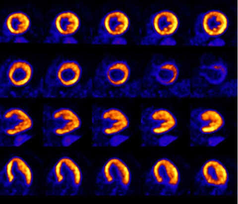 Vereos digital PET scan heart