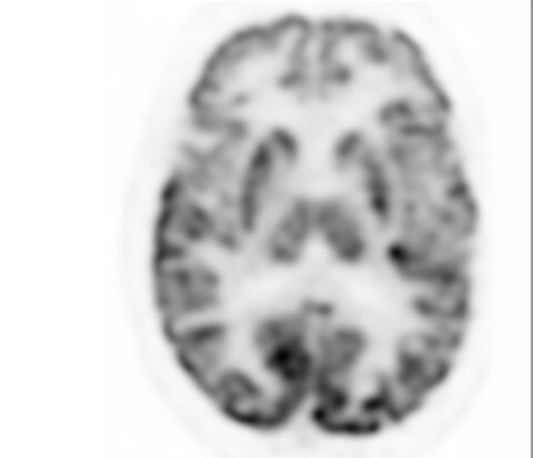 Vereos digital PET scan brain