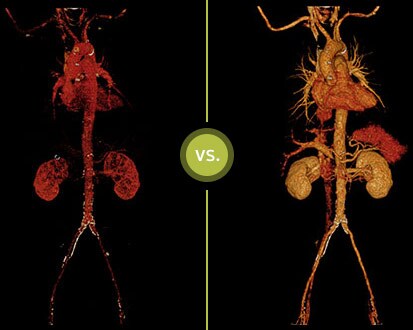 Conventional CT vs IQon Spectral CT