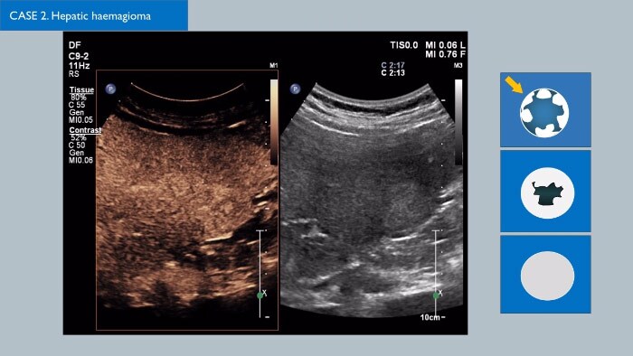 CEUS ContrastEnhanced Ultrasound Philips Healthcare